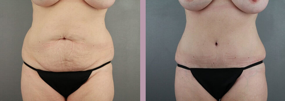 Case--22151 | Before and After Tummy Tuck