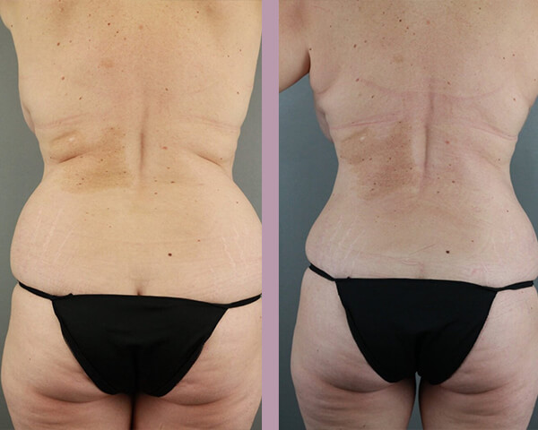 Case--22151 | Before and After Tummy Tuck 2