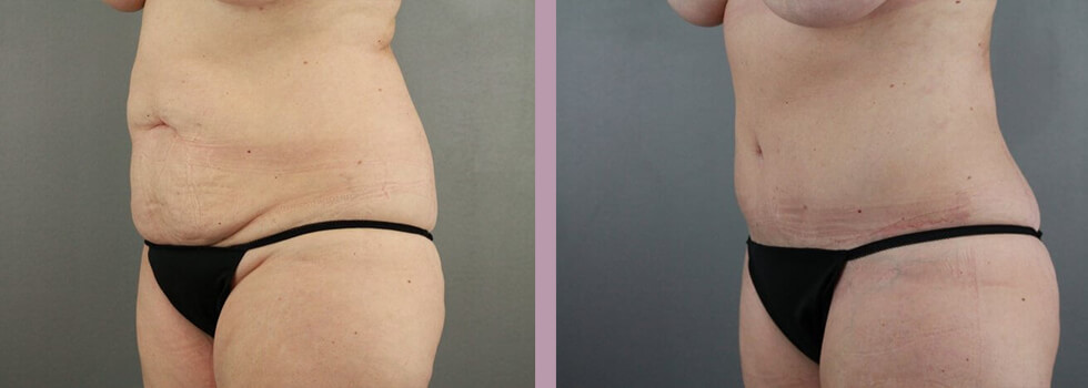 Case--22151 | Before and After Tummy Tuck 3