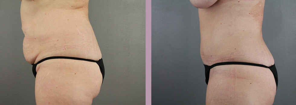 Case--22151 | Before and After Tummy Tuck 4