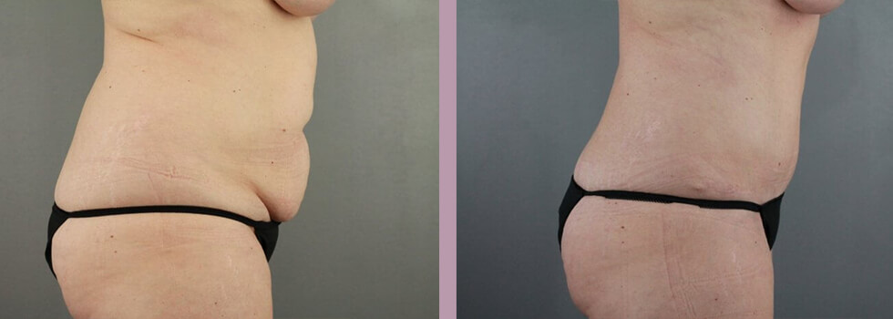 Case--22151 | Before and After Tummy Tuck 5