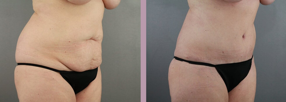 Case--22151 | Before and After Tummy Tuck 6