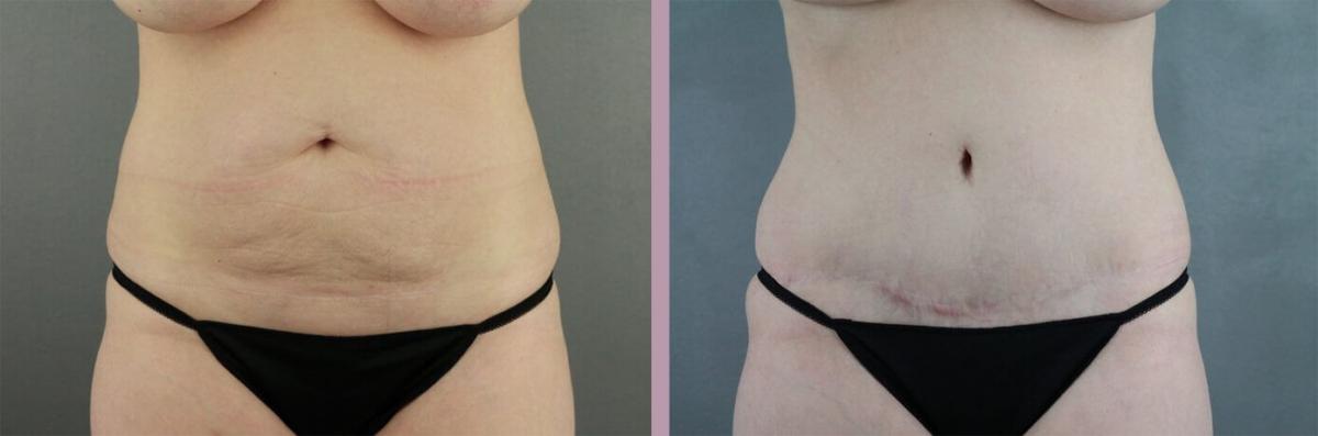 Case--22166 | Before and After Tummy Tuck