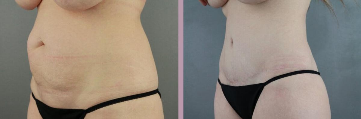 Case--22166 | Before and After Tummy Tuck 2