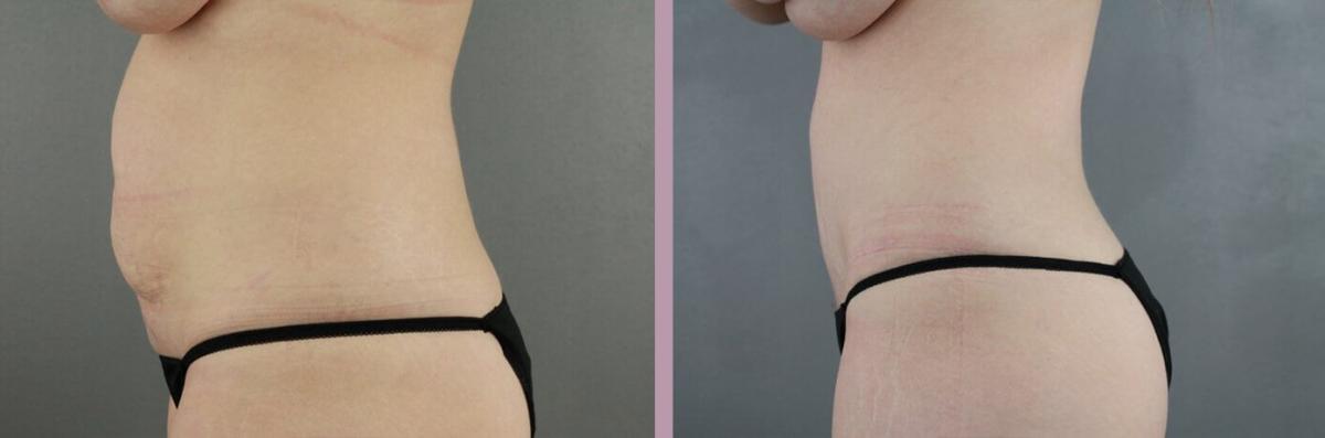 Case--22166 | Before and After Tummy Tuck 3