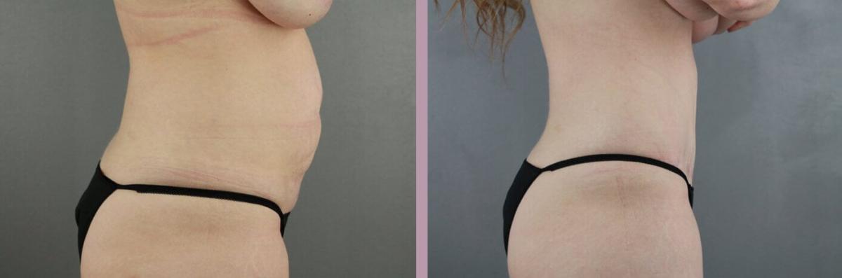 Case--22166 | Before and After Tummy Tuck 4
