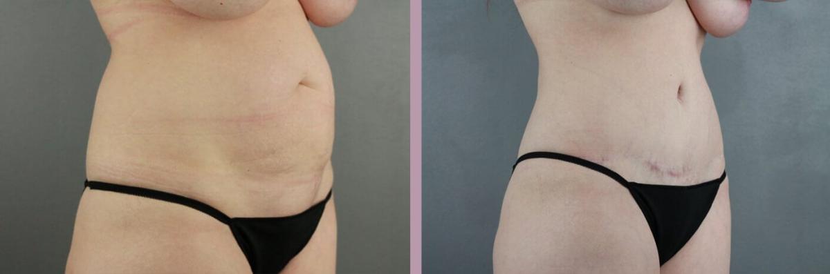 Case--22166 | Before and After Tummy Tuck 5
