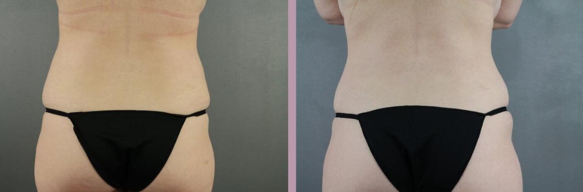 Case--22166 | Before and After Tummy Tuck 6