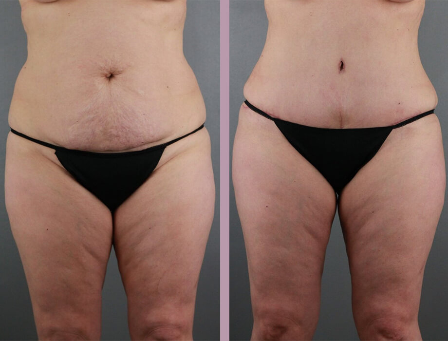 Case--22454 | Before and After Tummy Tuck