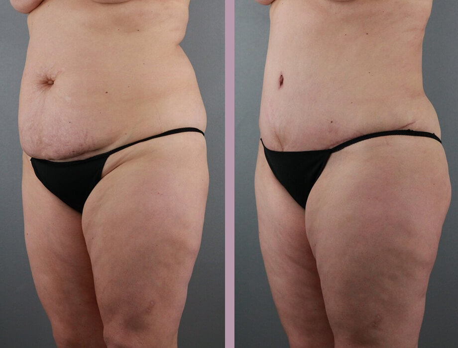 Case--22454 | Before and After Tummy Tuck 2