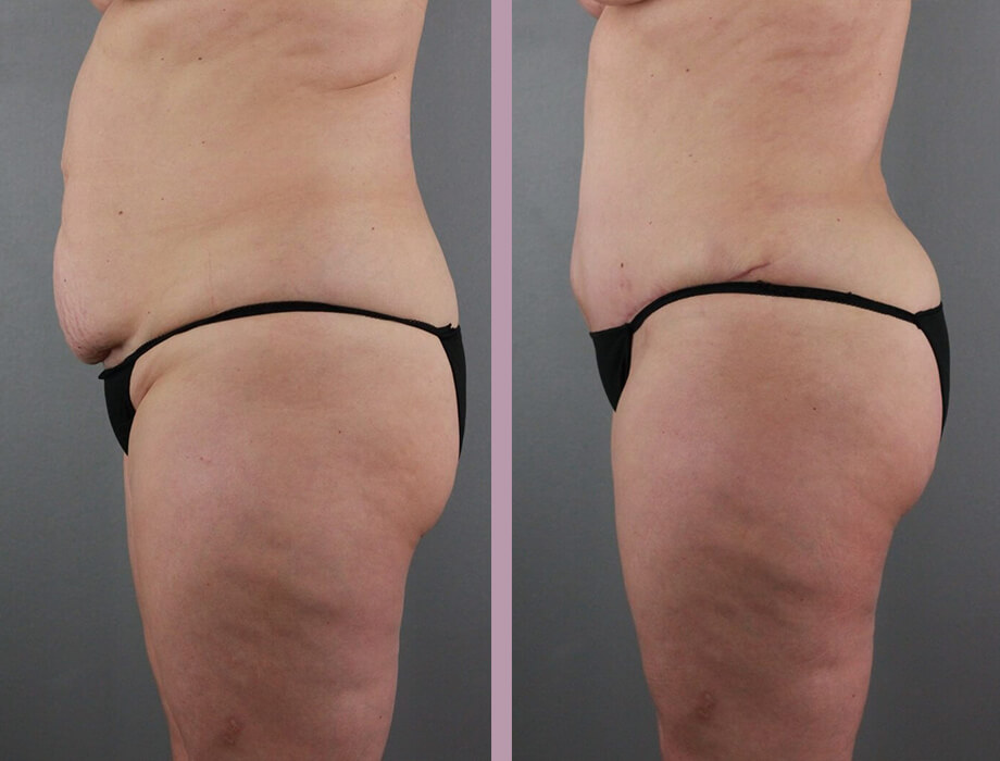 Case--22454 | Before and After Tummy Tuck 3