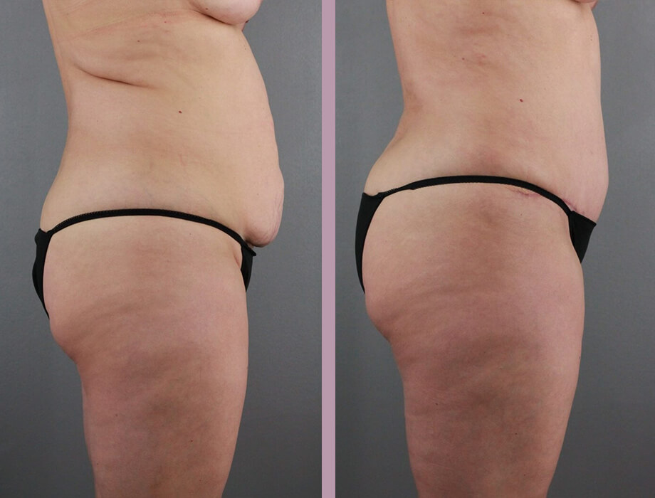 Case--22454 | Before and After Tummy Tuck 4