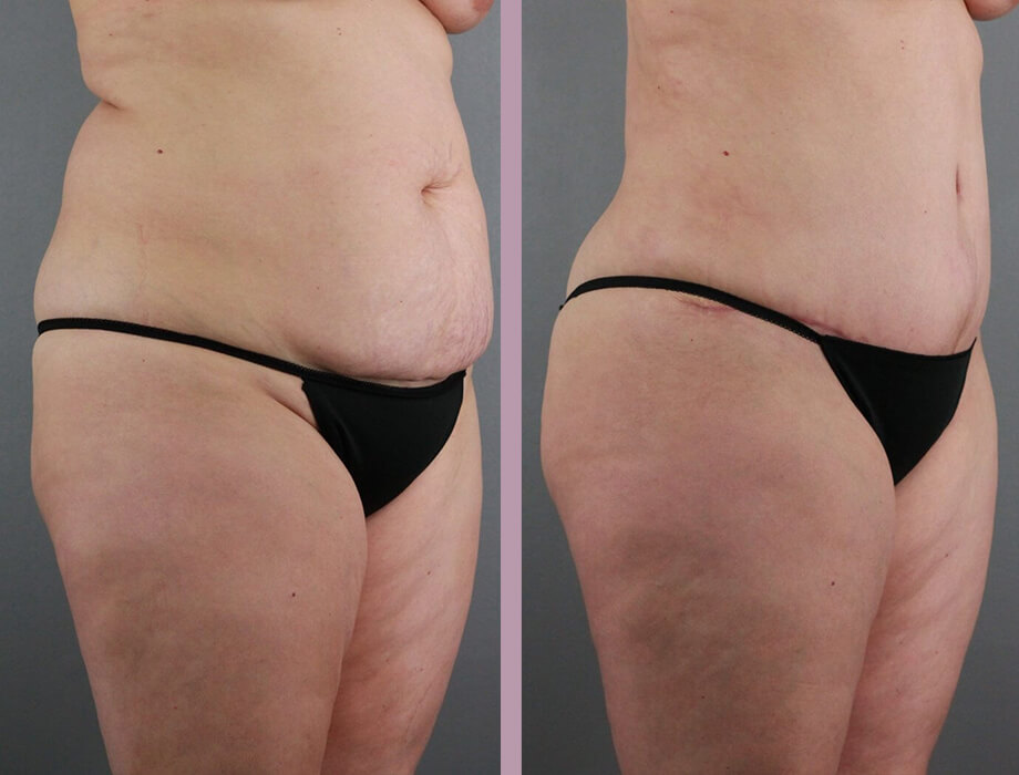 Case--22454 | Before and After Tummy Tuck 5