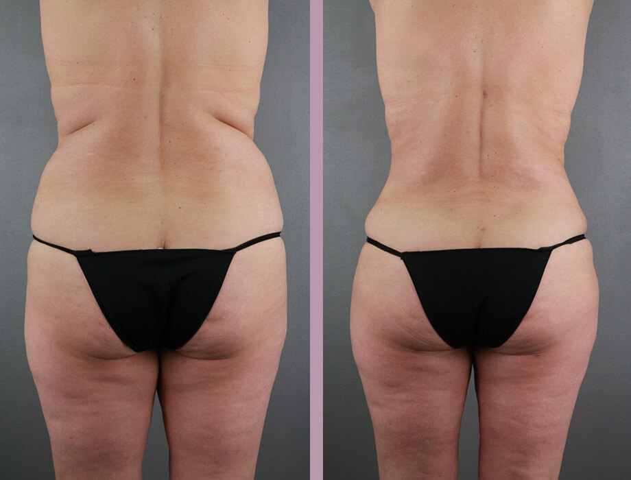 Case--22454 | Before and After Tummy Tuck 6