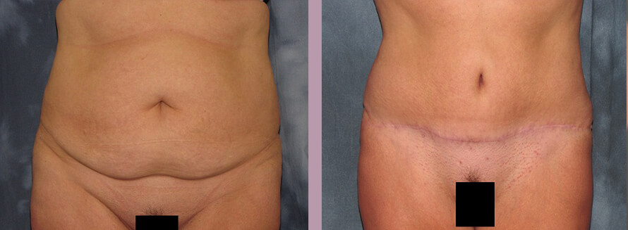 Case--2785 | Before and After Tummy Tuck