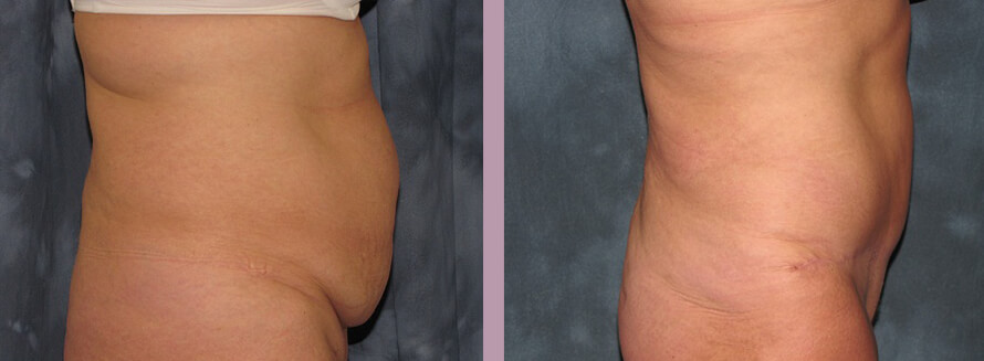 Case--2785 | Before and After Tummy Tuck 2