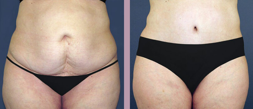 Case--3127 | Before and After Tummy Tuck