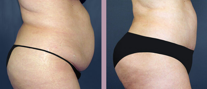 Case--3127 | Before and After Tummy Tuck 2