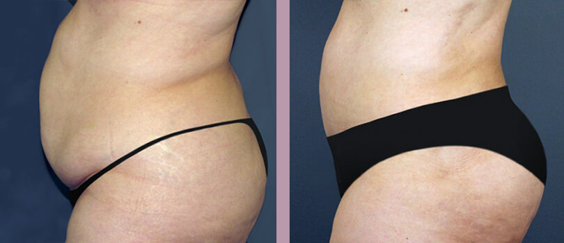 Case--3127 | Before and After Tummy Tuck 3