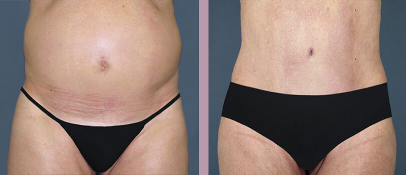 Case--3959 | Before and After Tummy Tuck