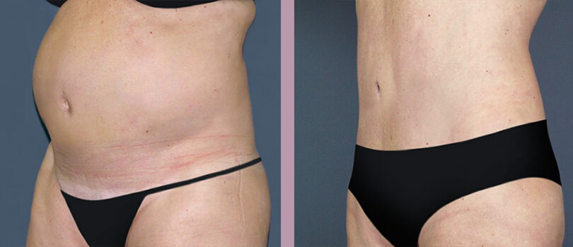 Case--3959 | Before and After Tummy Tuck 2