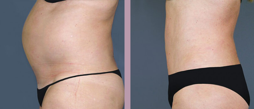 Case--3959 | Before and After Tummy Tuck 3