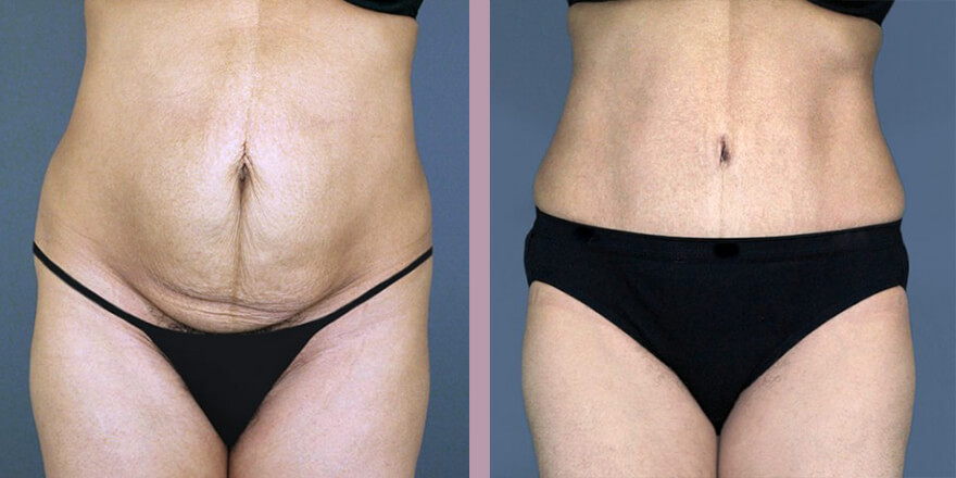 Case--3975 | Before and After Tummy Tuck