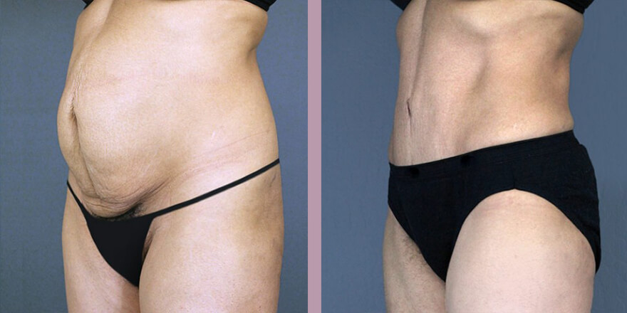Case--3975 | Before and After Tummy Tuck 2