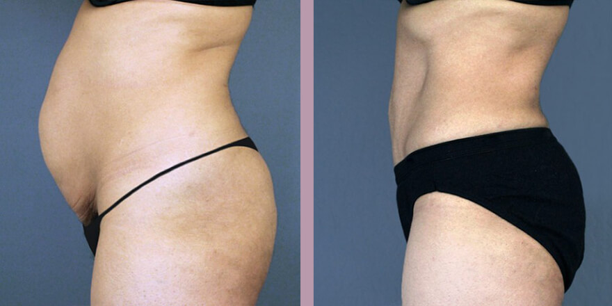 Case--3975 | Before and After Tummy Tuck 3