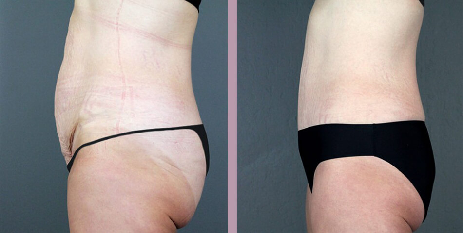Case--4548 | Before and After Tummy Tuck