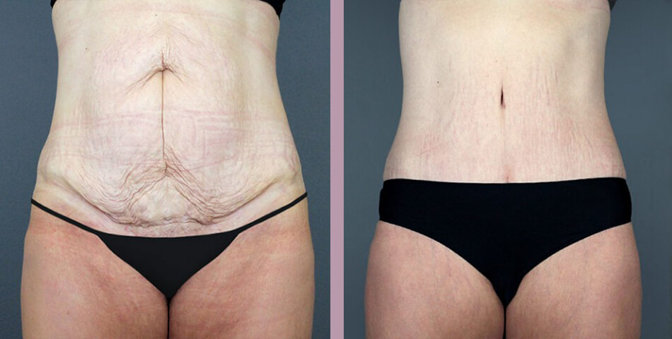 Tummy Tuck - Before and After Patient Results - 3