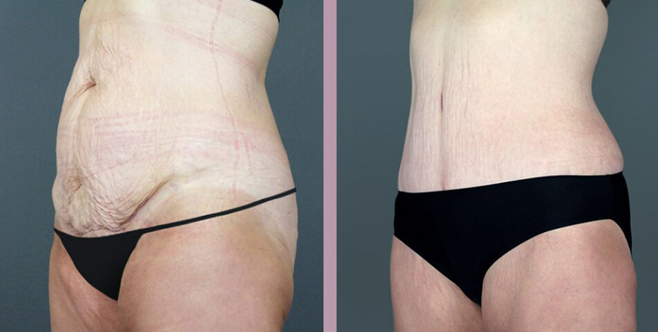 Case--4548 | Before and After Tummy Tuck 3