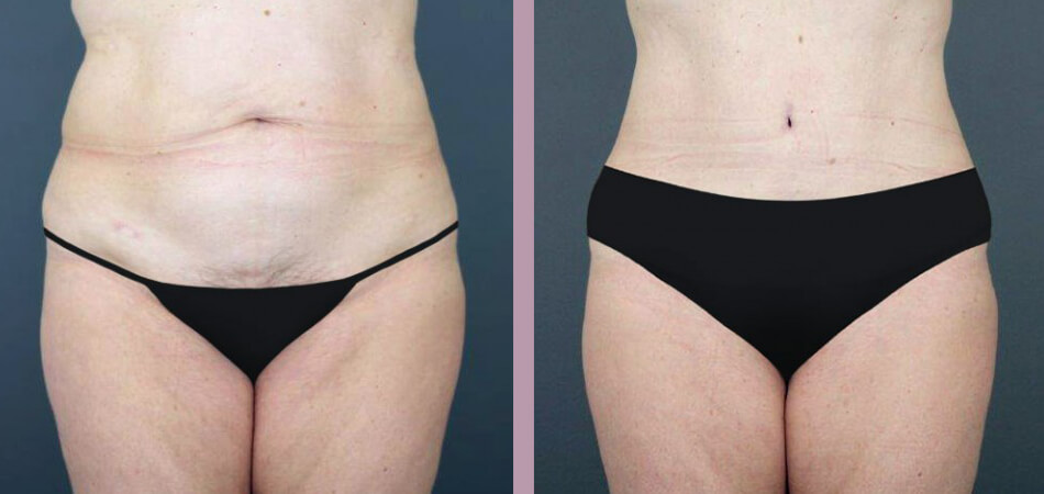 Case--4733 | Before and After Tummy Tuck