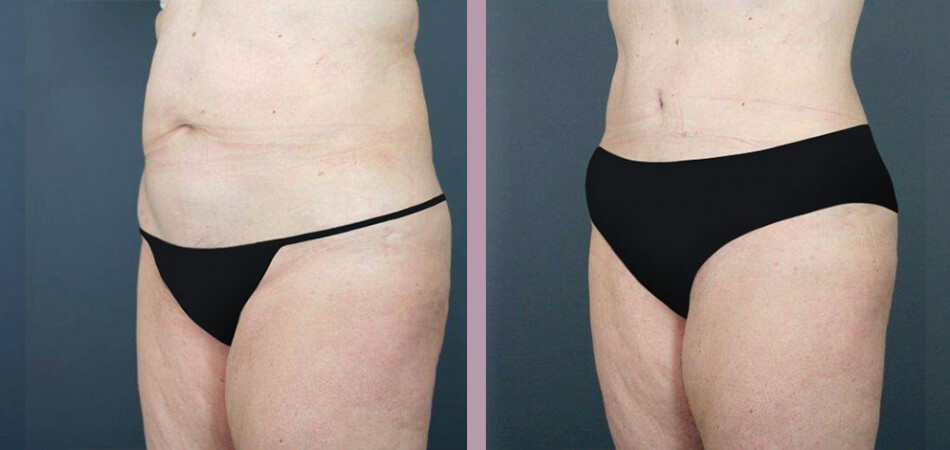 Case--4733 | Before and After Tummy Tuck 2