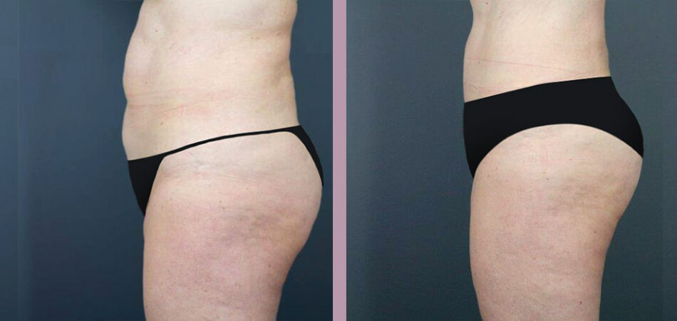 Case--4733 | Before and After Tummy Tuck 3