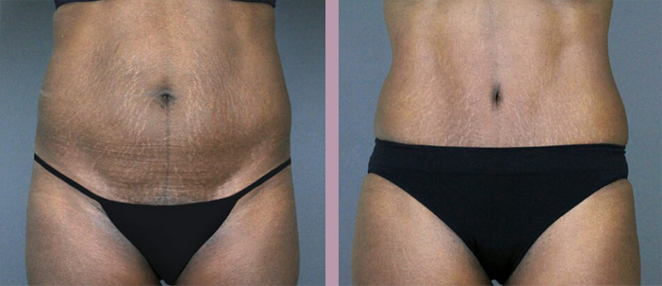 Case--4906 | Before and After Tummy Tuck