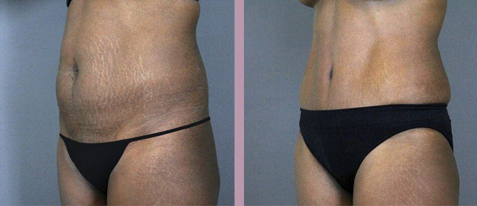 Case--4906 | Before and After Tummy Tuck 2