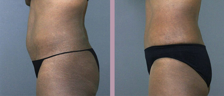 Case--4906 | Before and After Tummy Tuck 3