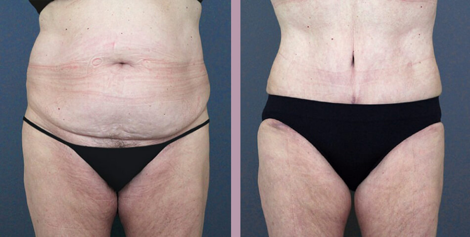 Case--5073 | Before and After Tummy Tuck