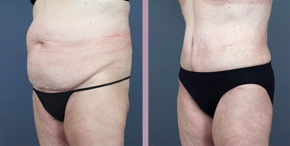 Case--5073 | Before and After Tummy Tuck 2
