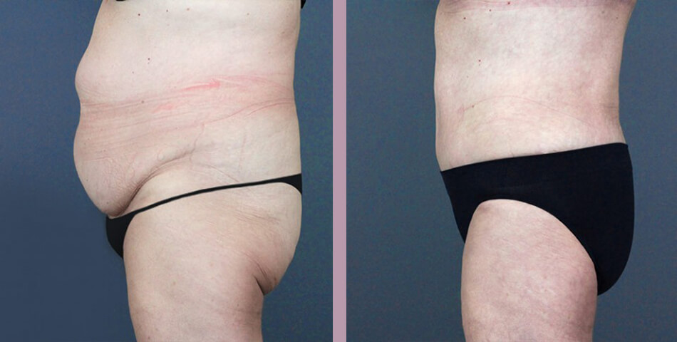 Case--5073 | Before and After Tummy Tuck 3