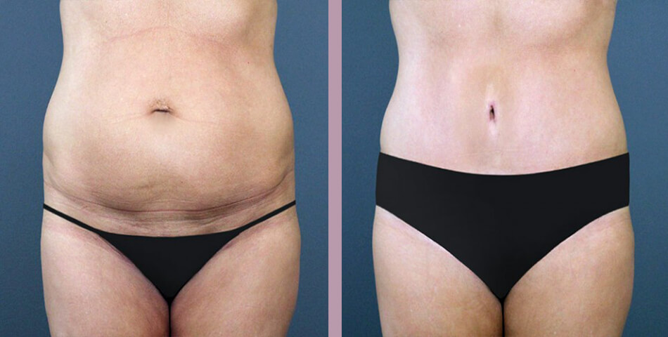Tummy Tuck - Before and After Patient Results - 1