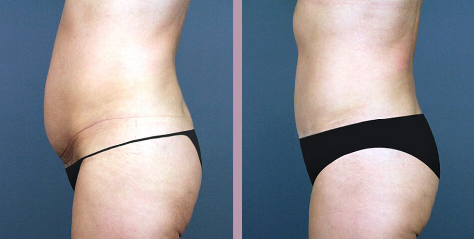 Case--5081 | Before and After Tummy Tuck 2