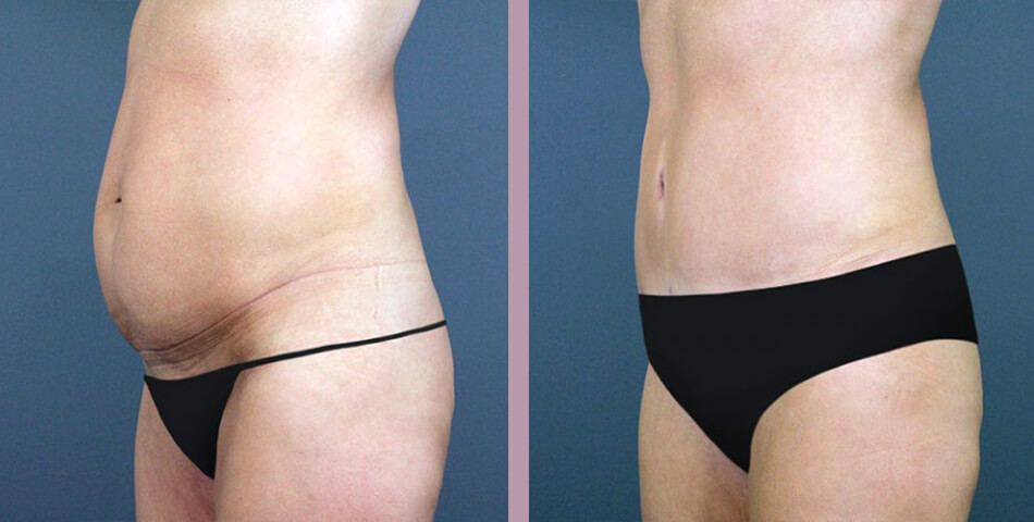 Case--5081 | Before and After Tummy Tuck 3