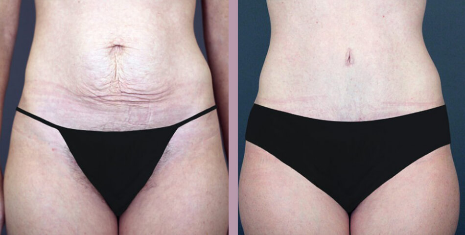 Tummy Tuck - Before and After Patient Results - 2