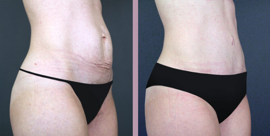 Case--5091 | Before and After Tummy Tuck 2