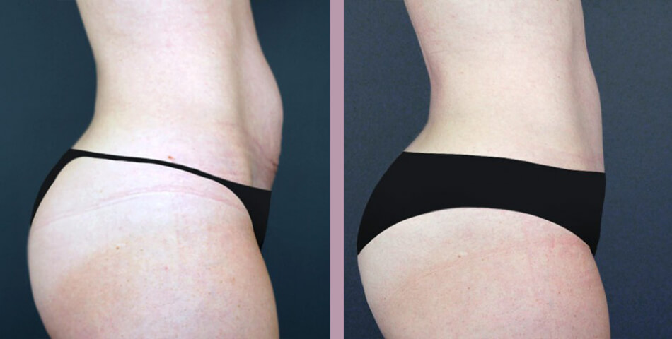 Case--5091 | Before and After Tummy Tuck 3