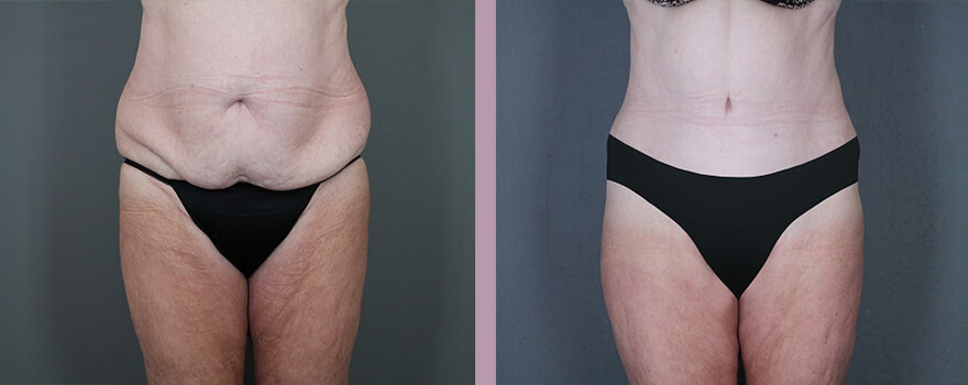 Case--5518 | Before and After Tummy Tuck