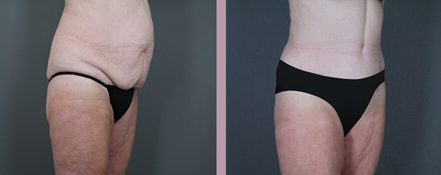 Case--5518 | Before and After Tummy Tuck 2