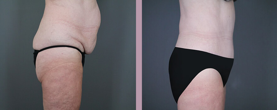 Case--5518 | Before and After Tummy Tuck 3